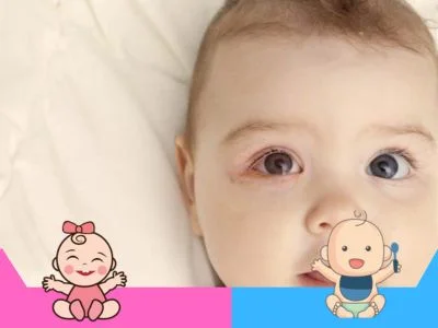 Conjuntivitis en bebés