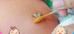 cordón umbilical infectado